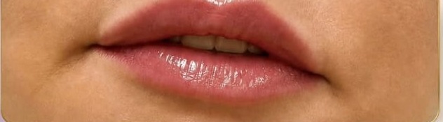 Lábios depois do preenchimento labial